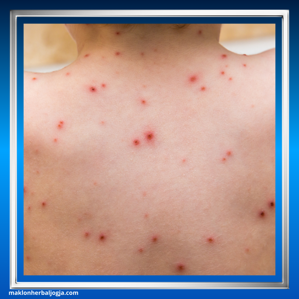 Cara Mengobati Cacar Air