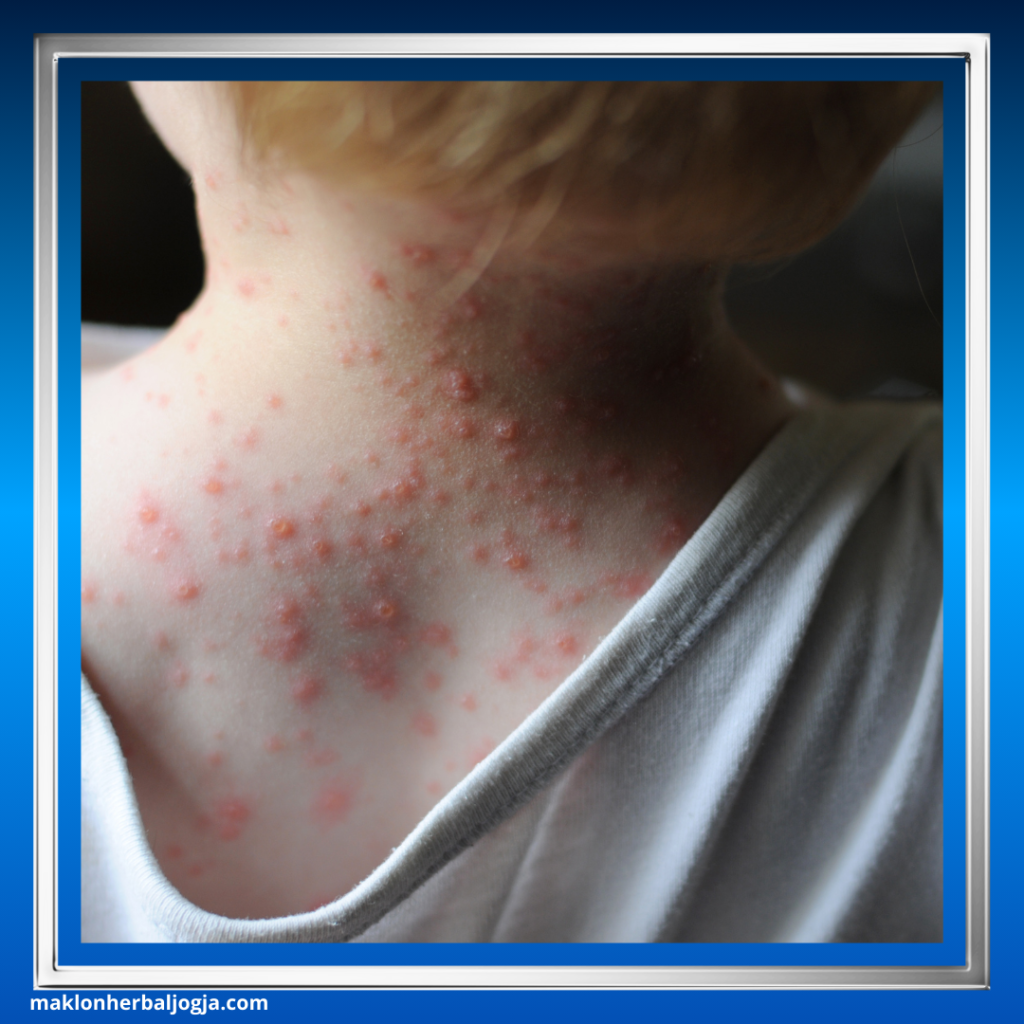 Cara Mengobati Cacar Air