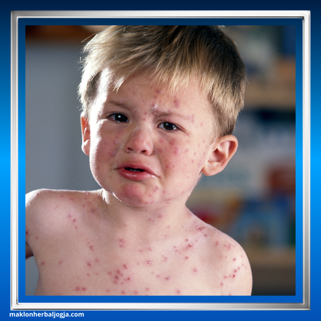 Cara Mengobati Cacar Air