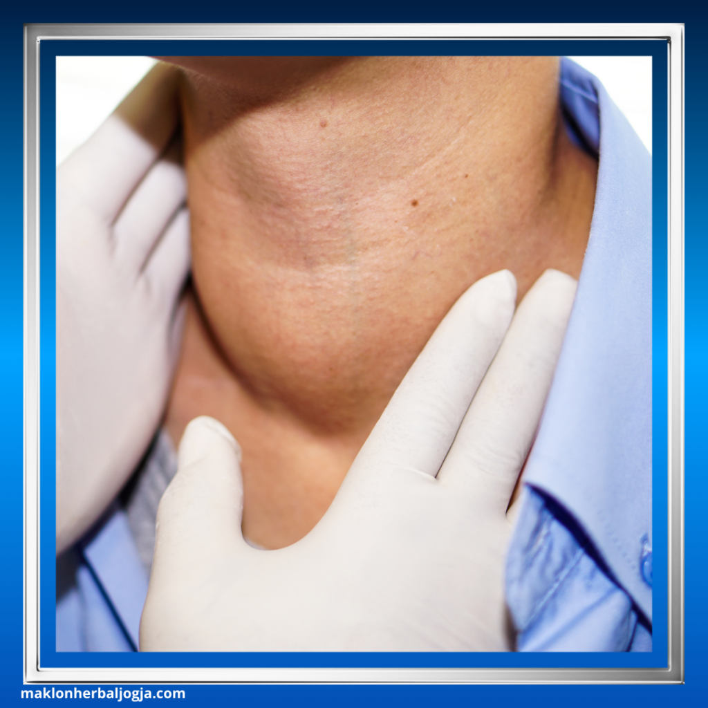 Cara Mengobati Gondok dengan Herbal