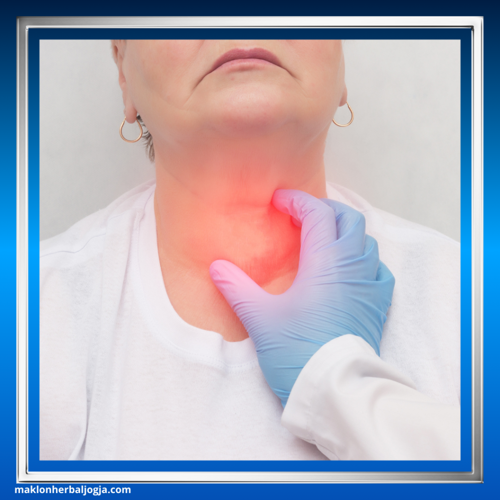 Cara Mengobati Gondok dengan Herbal