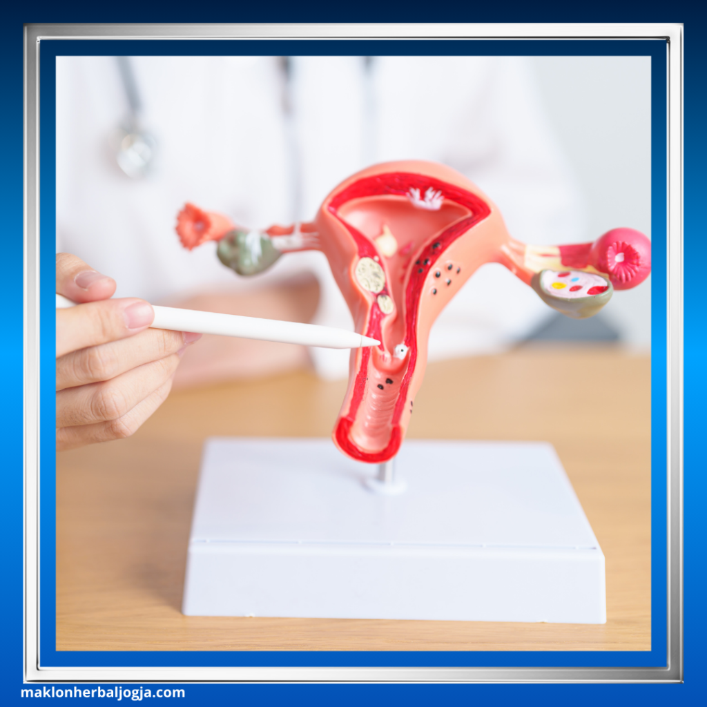 Cara Mengatasi Haid Tidak Teratur