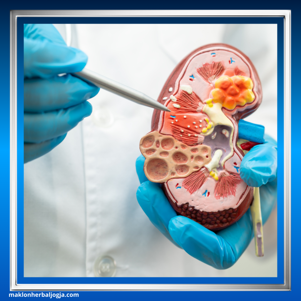 Ciri Penyakit Ginjal Akut