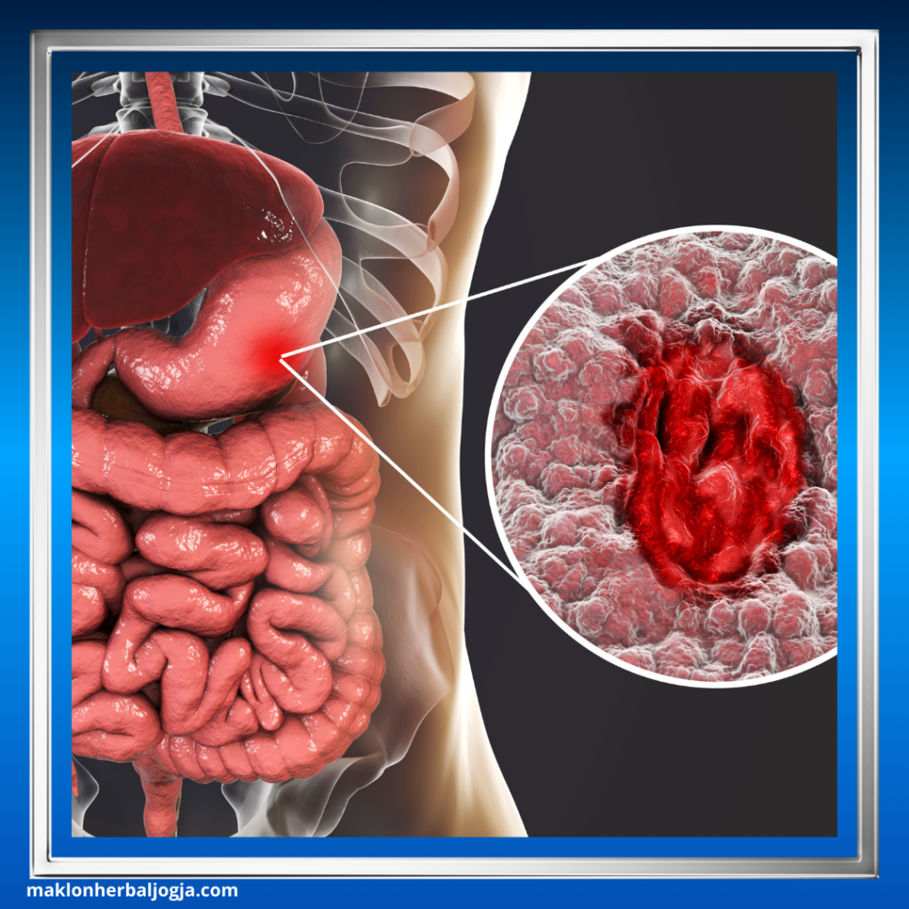 Mengatasi Asam Lambung Kronis