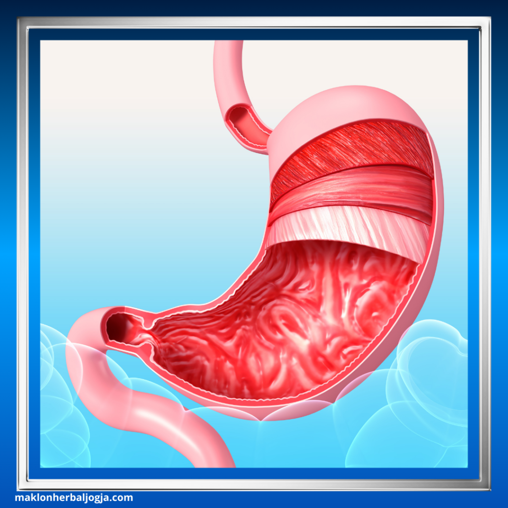 Mengatasi Asam Lambung Kronis