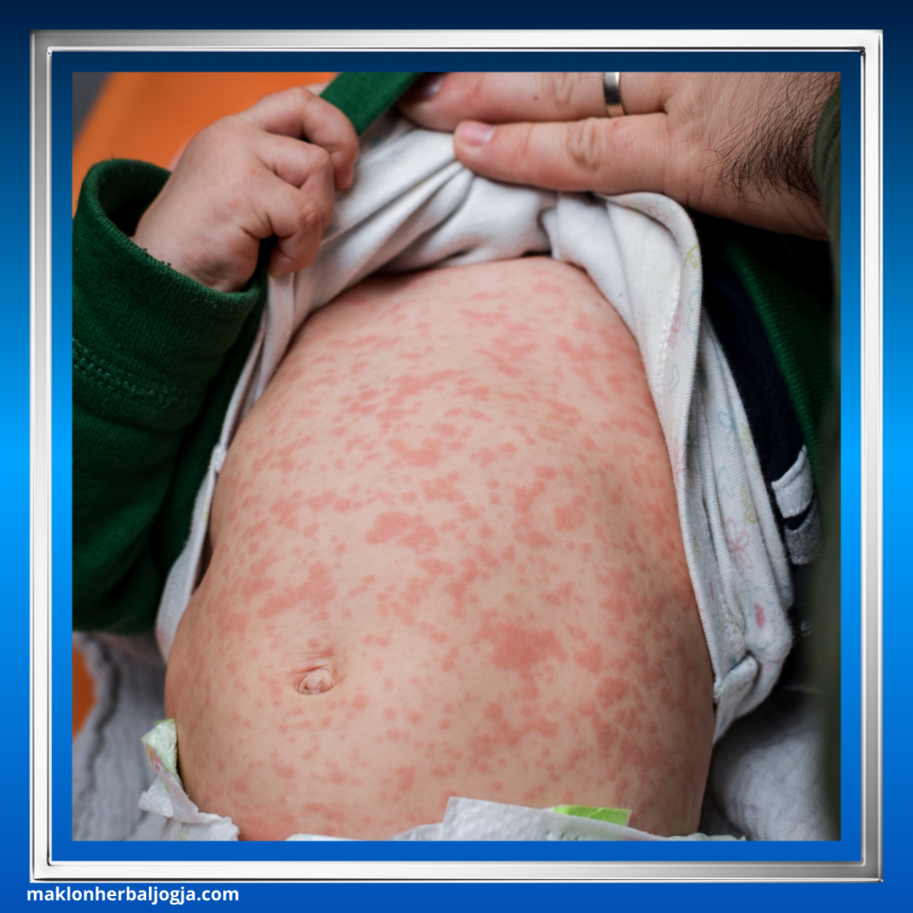 Cara Mencegah Campak
