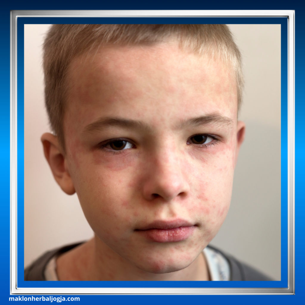 Cara Mencegah Campak