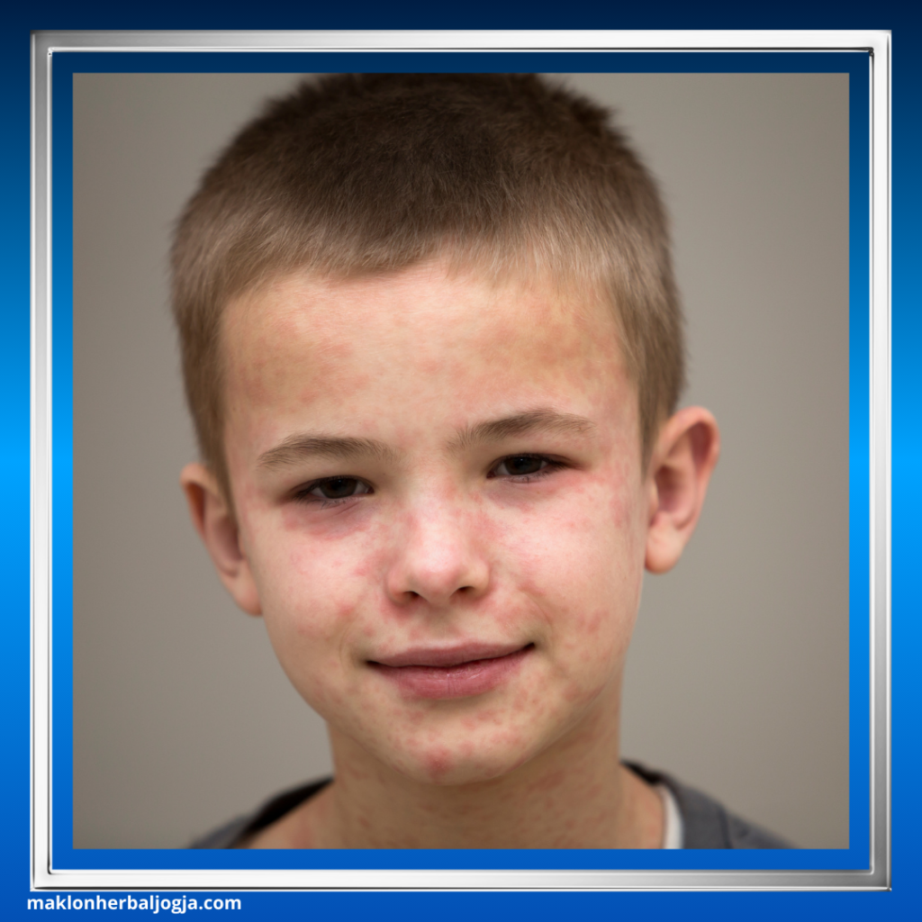 Cara Mencegah Campak