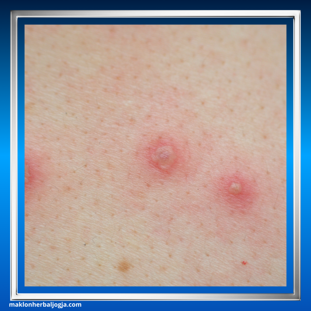 Mengenal Penyakit Cacar