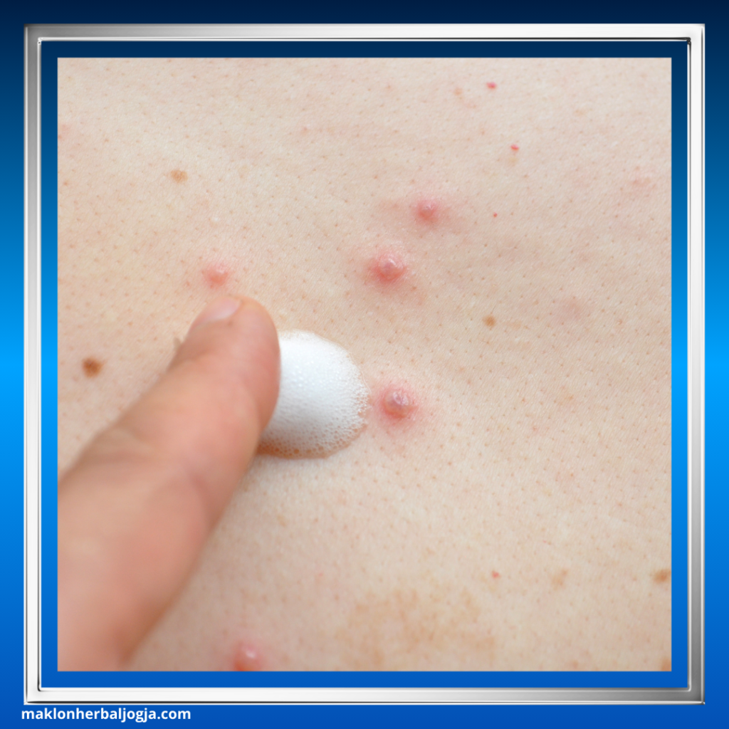 Mengenal Penyakit Cacar