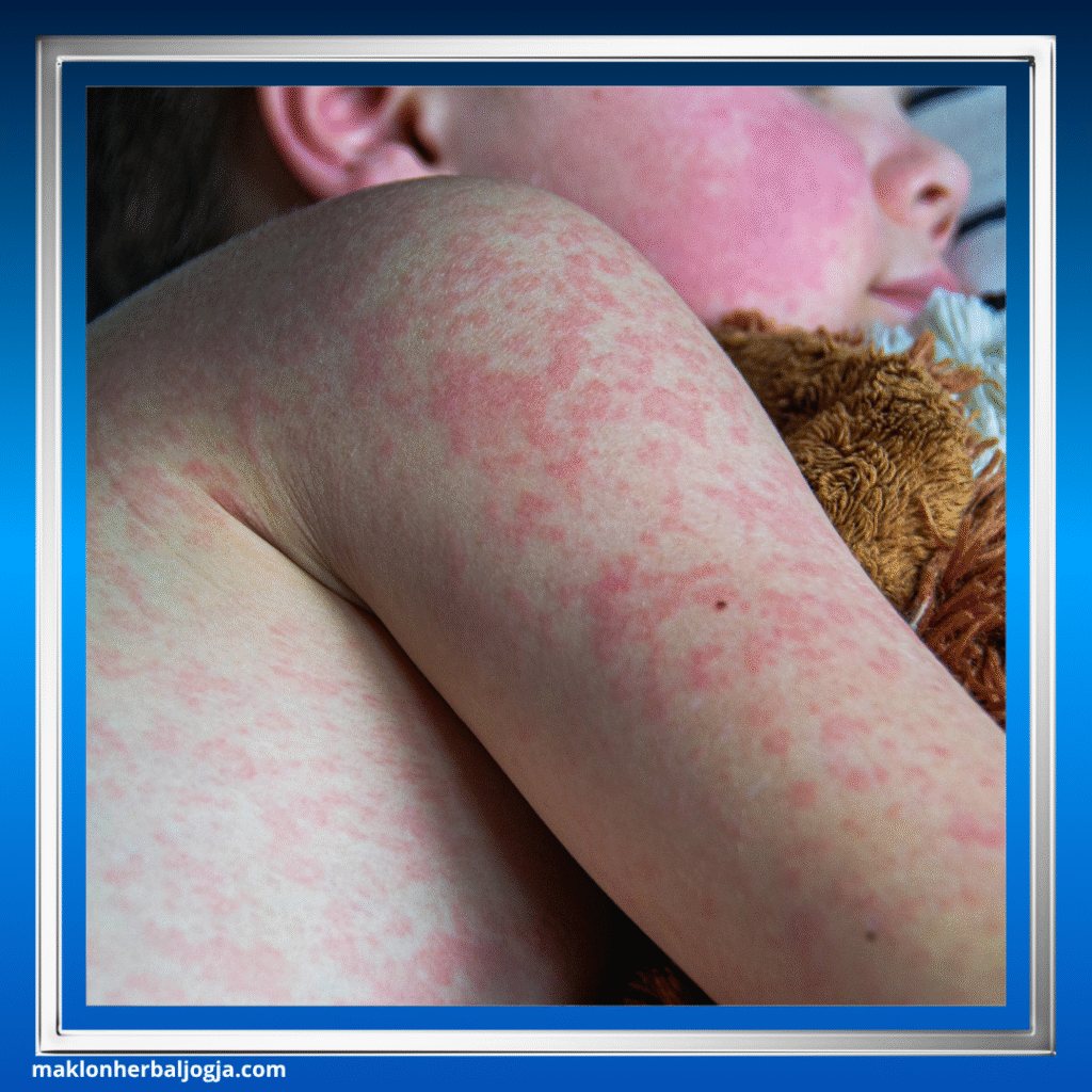 Jenis Penyakit Menular