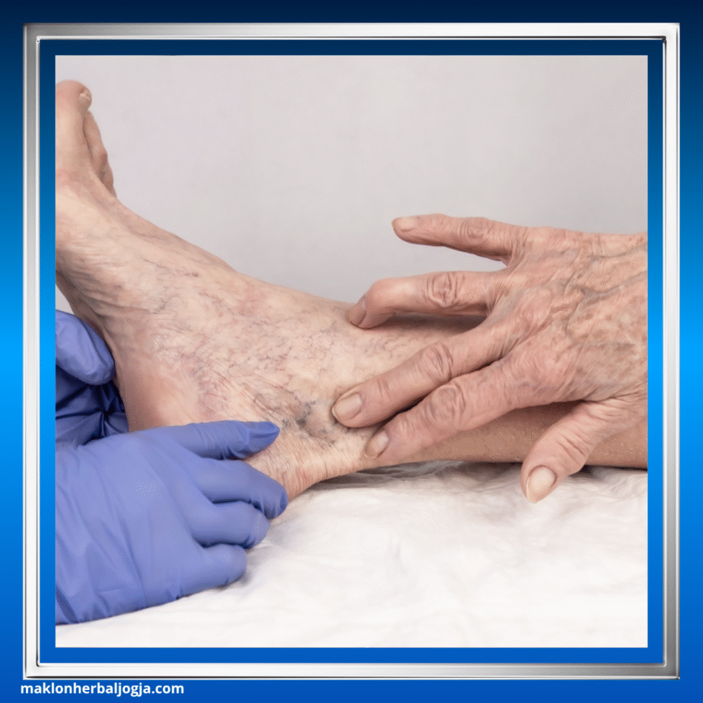 Herbal Meredakan Varises