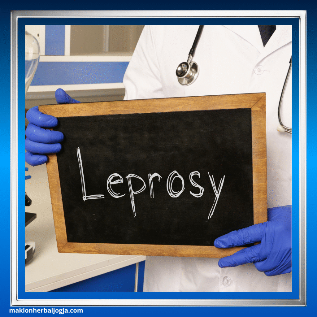 Penyakit Lepra