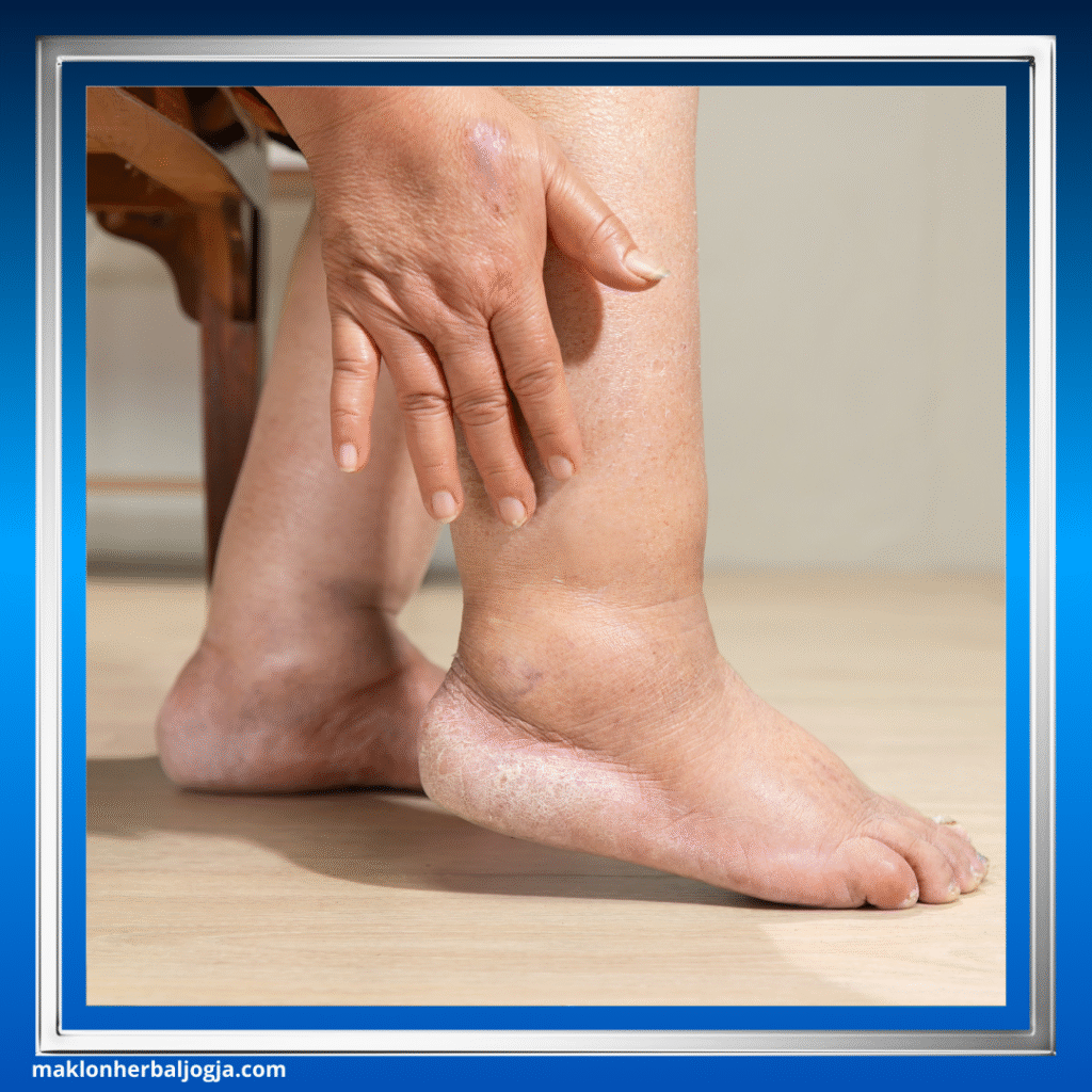 Ciri Penyakit Ginjal