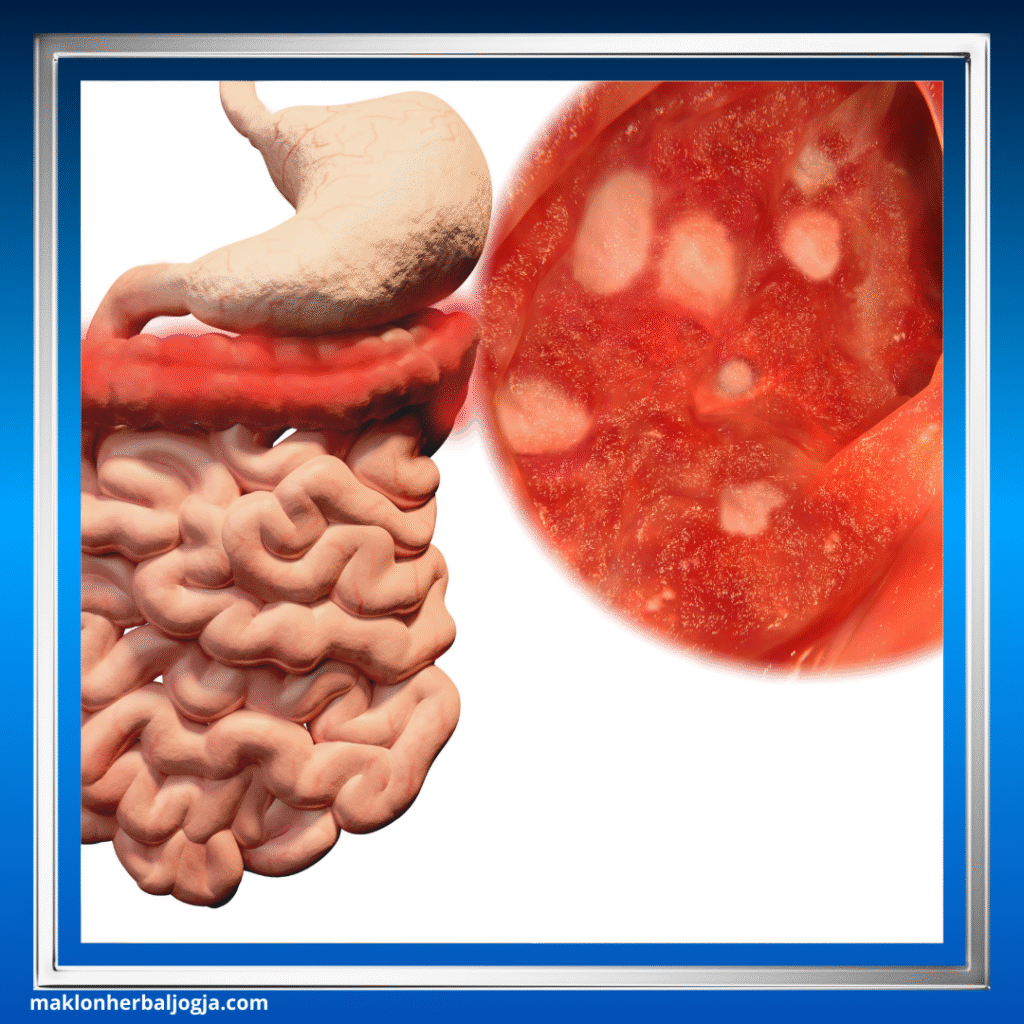Penyakit Radang Usus