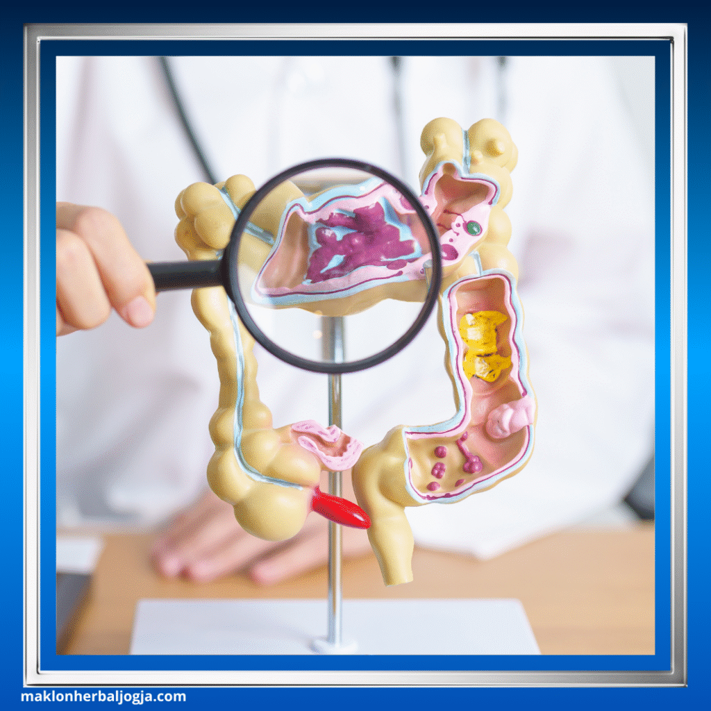 Penyakit Radang Usus