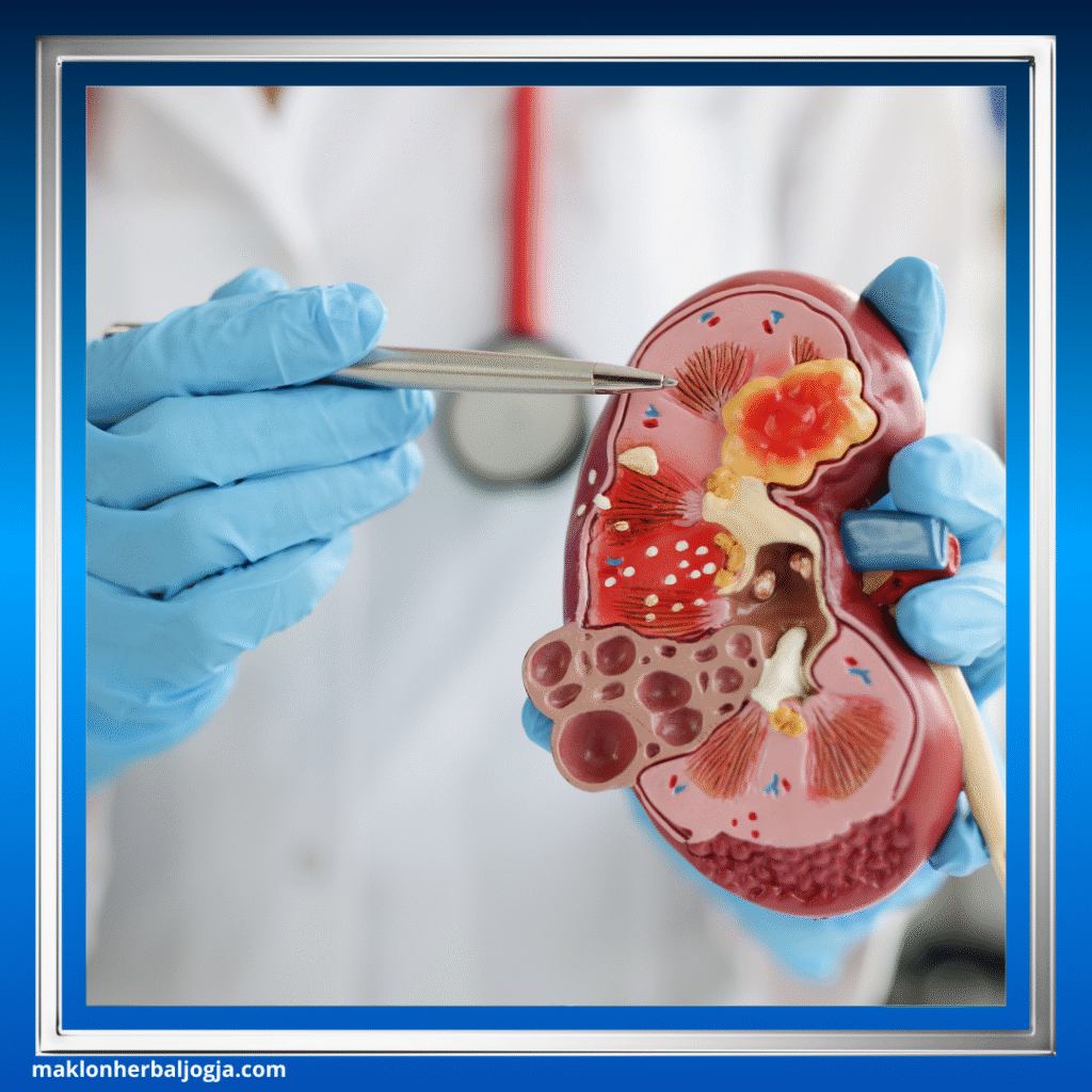 Herbal Penghancur Batu Ginjal