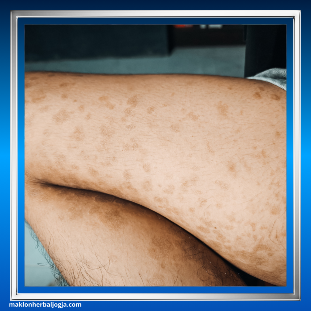 Penyakit Jamur Kulit