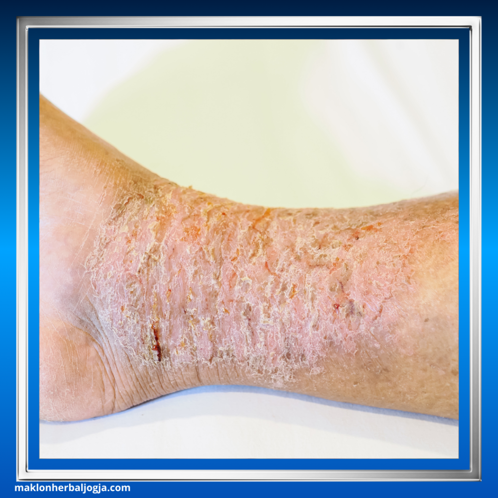 Penyakit Jamur Kulit