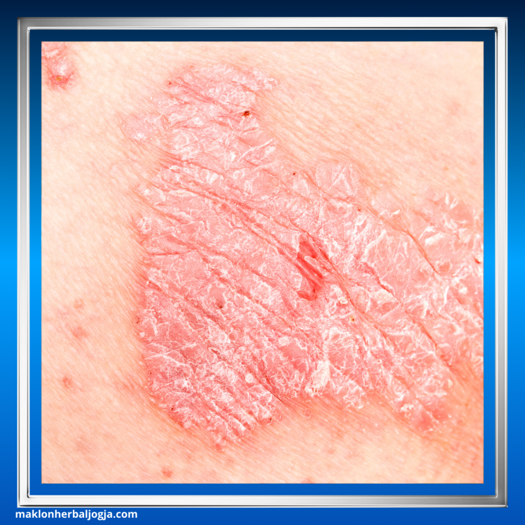Penyakit Jamur Kulit