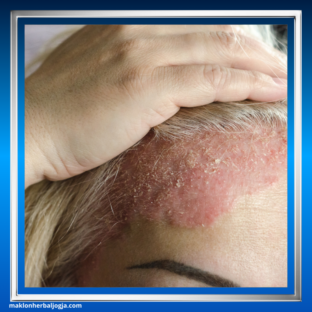Penyakit Jamur Kulit